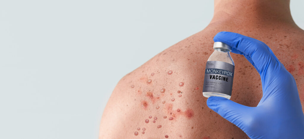 doctor s hand holding monkeypox vaccine with male 2023 11 27 05 21 31 utc scaled
