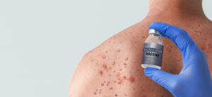 doctor s hand holding monkeypox vaccine with male 2023 11 27 05 21 31 utc scaled