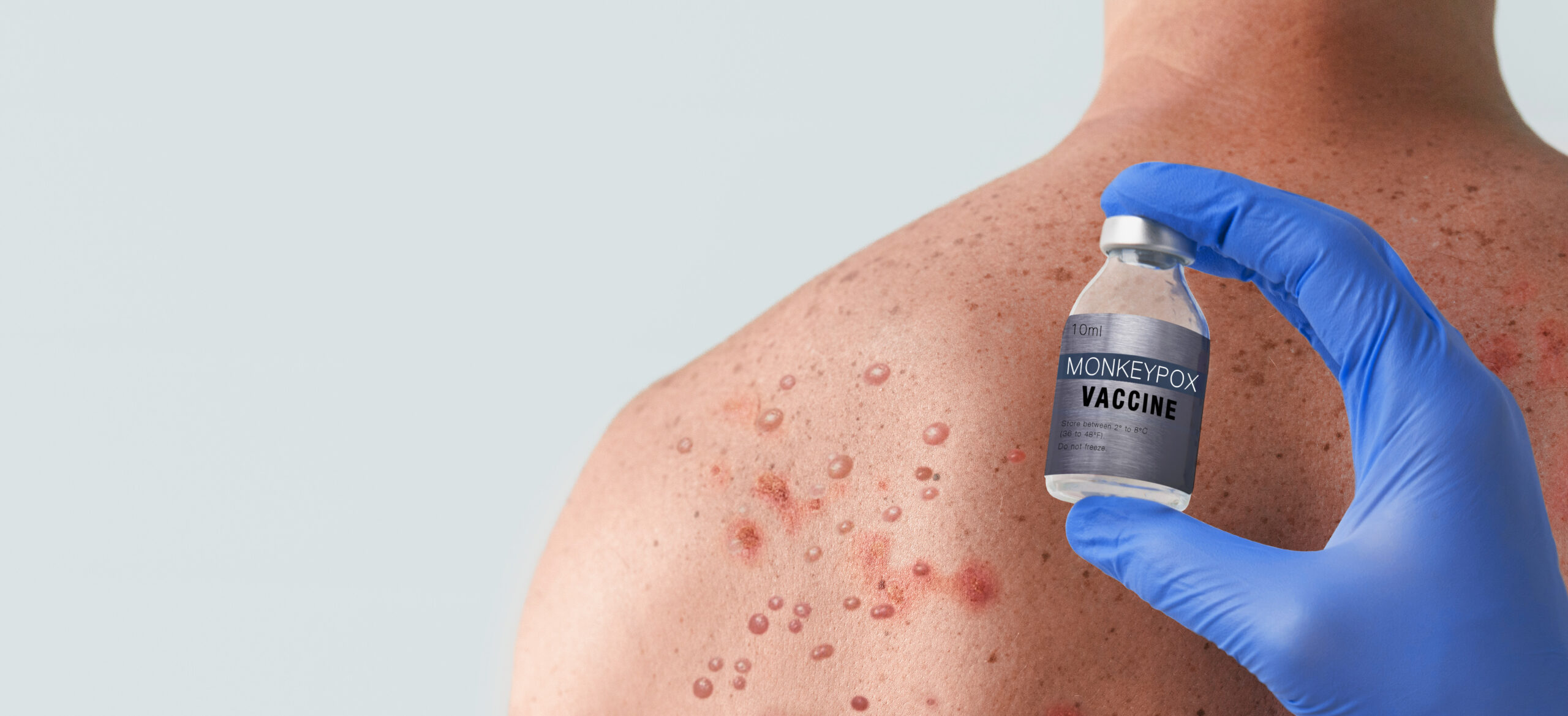 doctor s hand holding monkeypox vaccine with male 2023 11 27 05 21 31 utc scaled