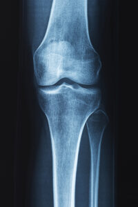 x ray of human knee problems with bone or joint 2023 11 27 05 11 46 utc scaled